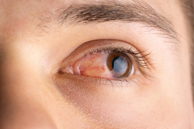 Infekcje oczu a łzawienie