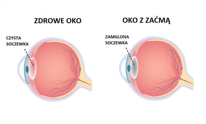 porównanie oka zdrowego i oka z zaćmą schemat