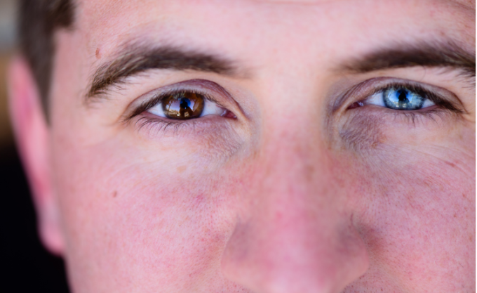 heterochromia oczu, mężczyzna z dwukolorowymi oczami