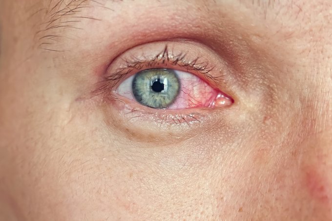 Zaczerwienienie, ból, ciała obcego w oku.